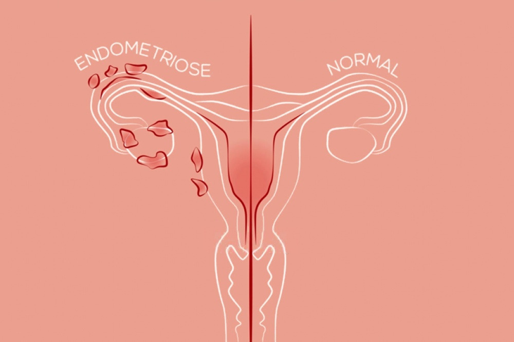 Gestrinona (vulgo chip da beleza): o melhor tratamento não cirúrgico para endometriose. 
