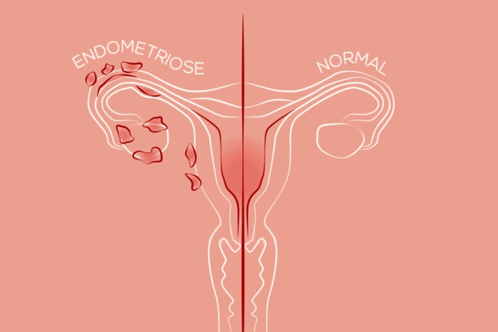 Gestrinona (vulgo chip da beleza): o melhor tratamento não cirúrgico para endometriose.