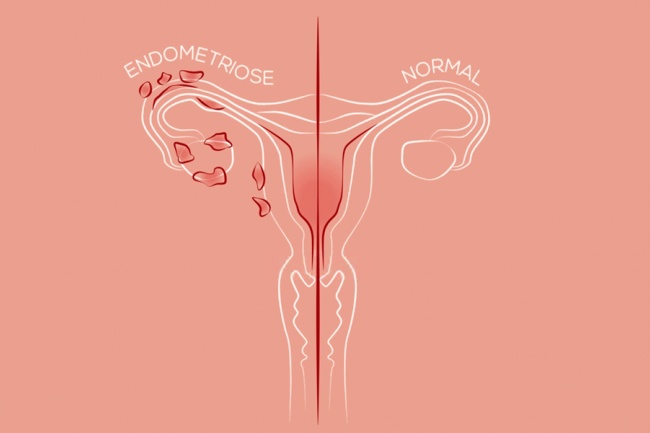 Gestrinona (vulgo chip da beleza): o melhor tratamento não cirúrgico para endometriose. 