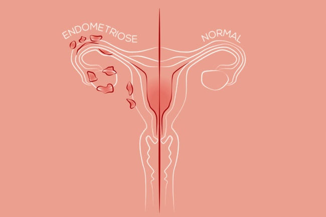 Gestrinona (vulgo chip da beleza): o melhor tratamento não cirúrgico para endometriose.